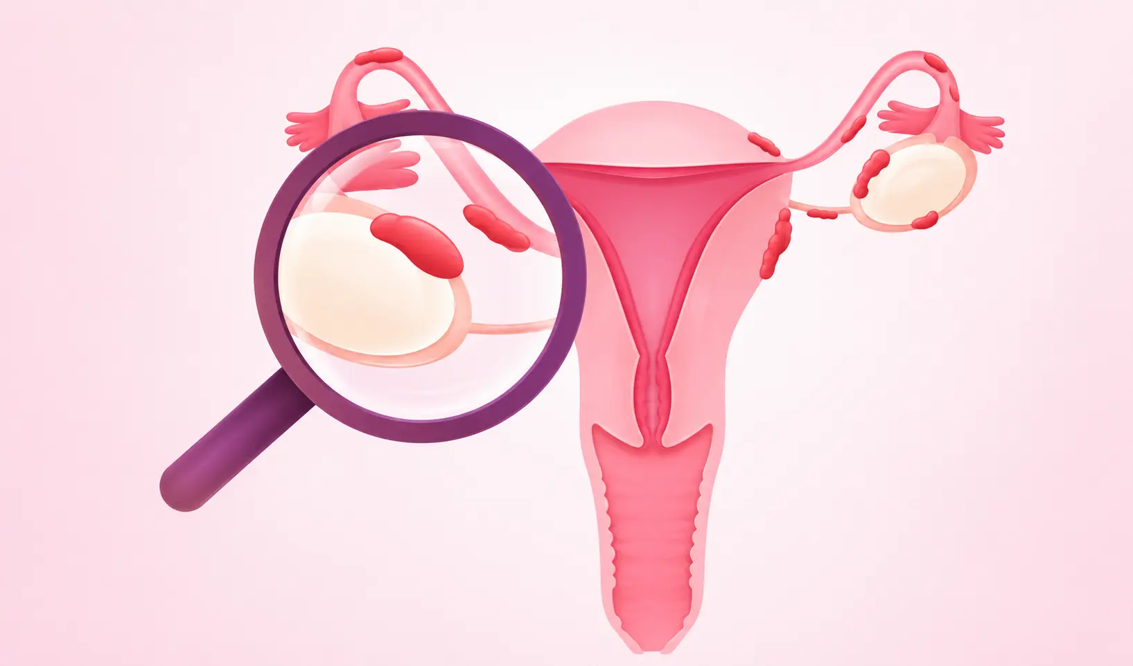 Endometriosis